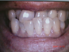 高村歯科矯正治療前写真